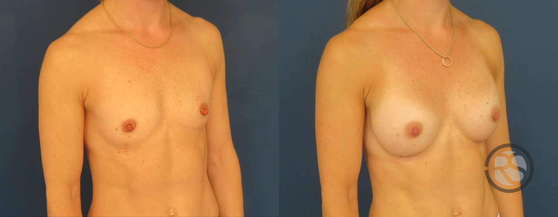 Before photo - Angle 4