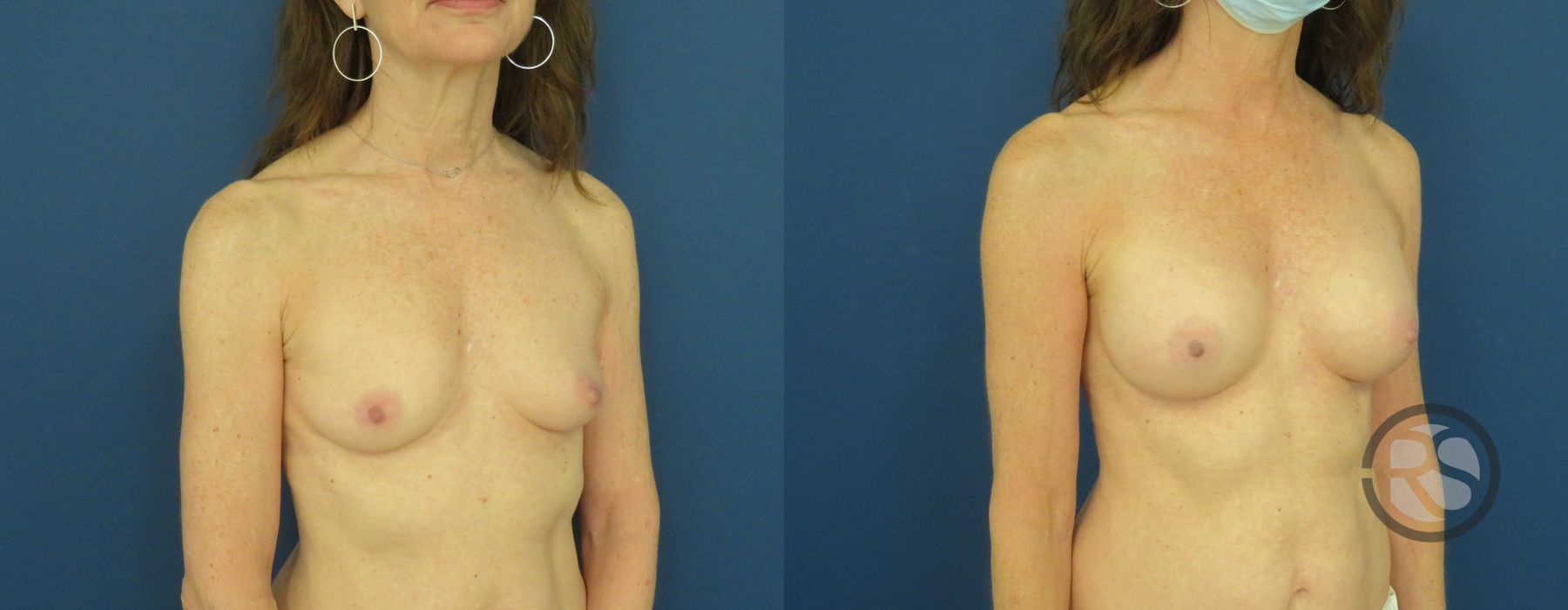 Before photo - Angle 2