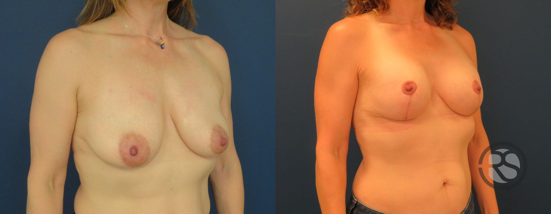 Before photo - Angle 2