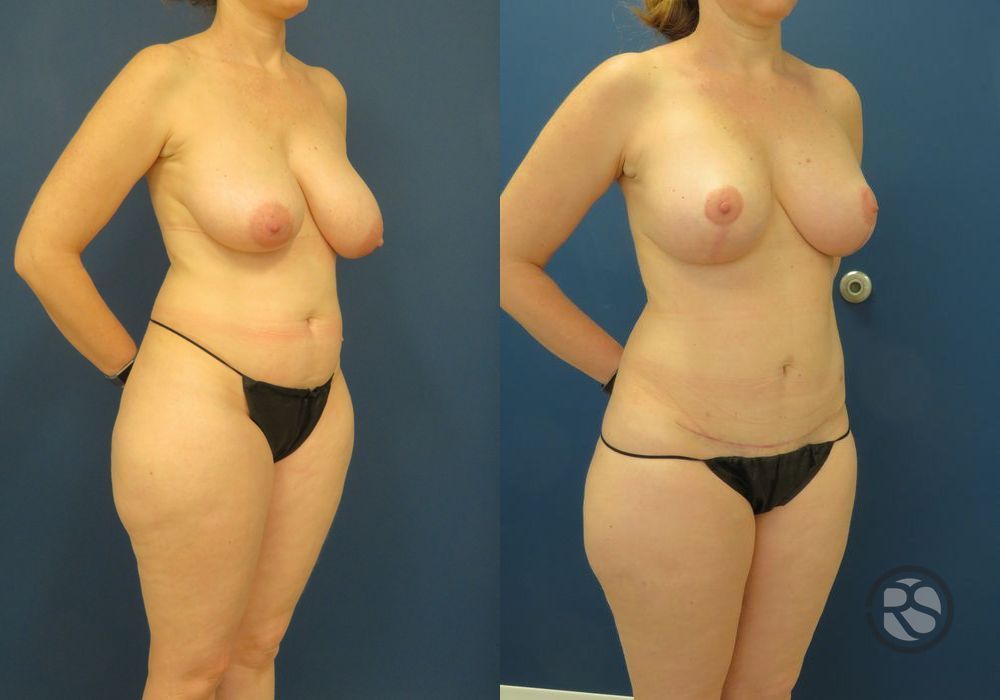 Before photo - Angle 2