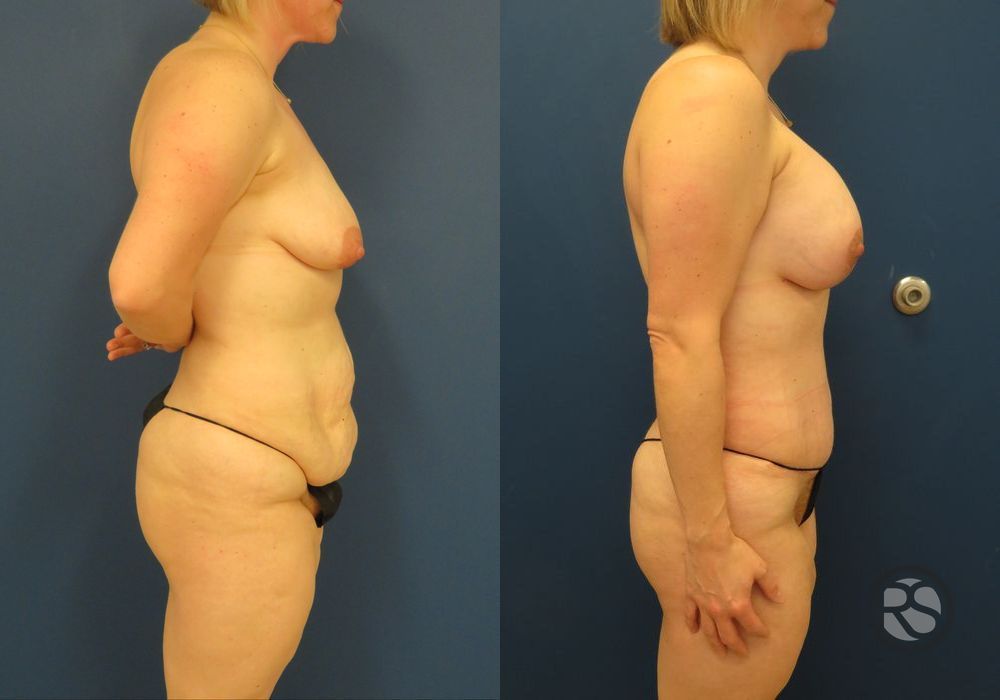 Before photo - Angle 3