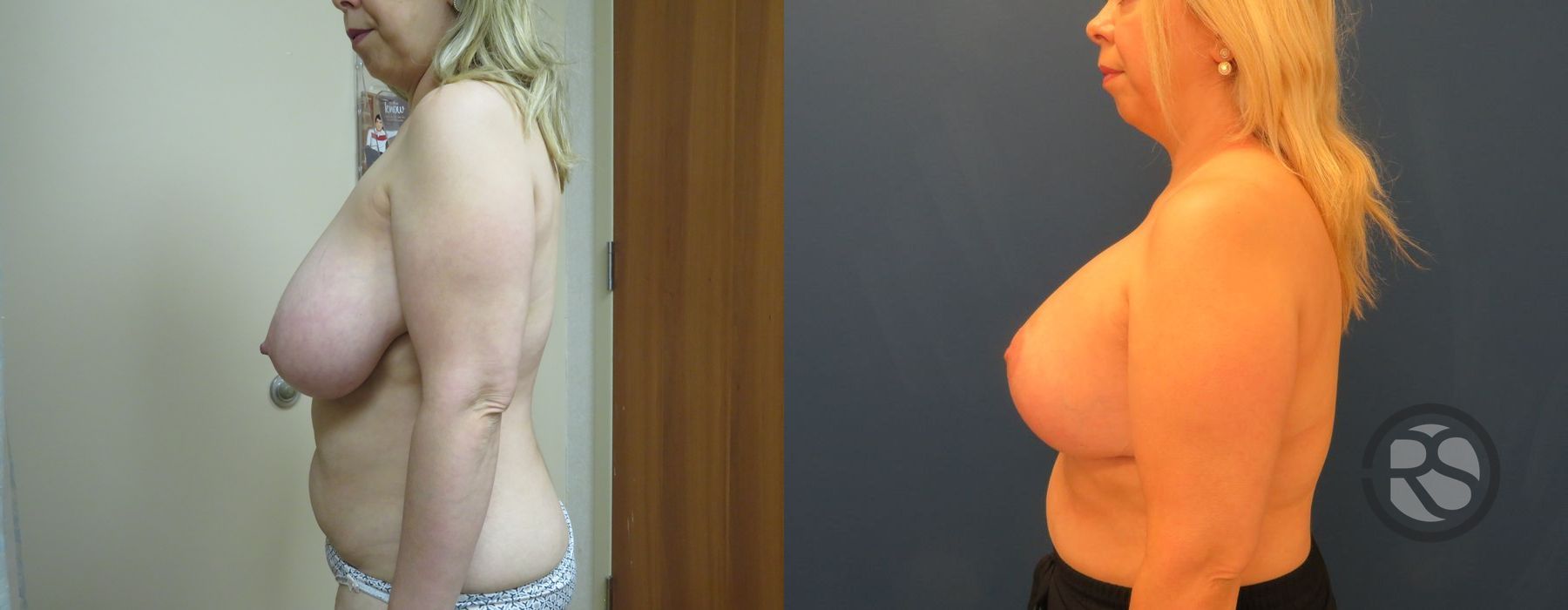 Before photo - Angle 5