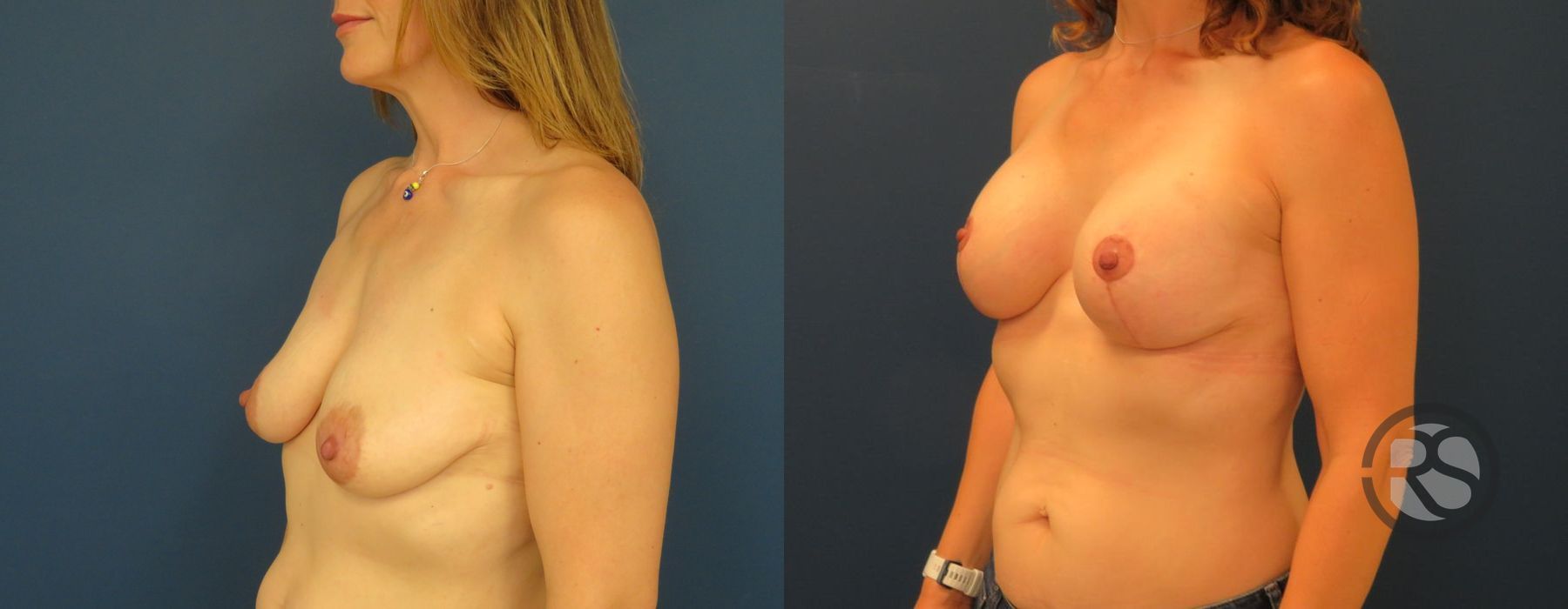 Before photo - Angle 4