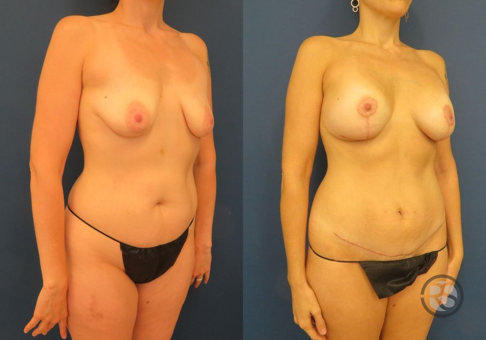 Before photo - Angle 2