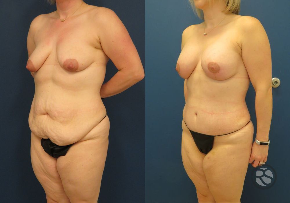 Before photo - Angle 4