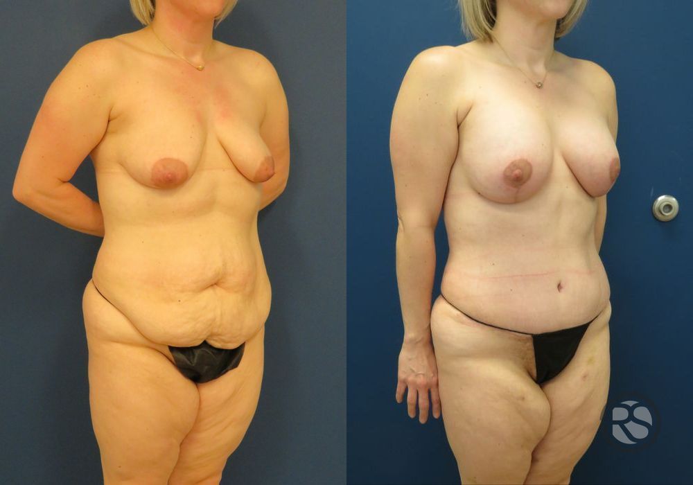 Before photo - Angle 2