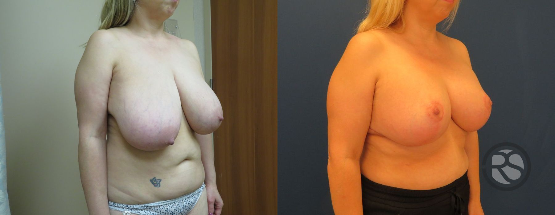 Before photo - Angle 2