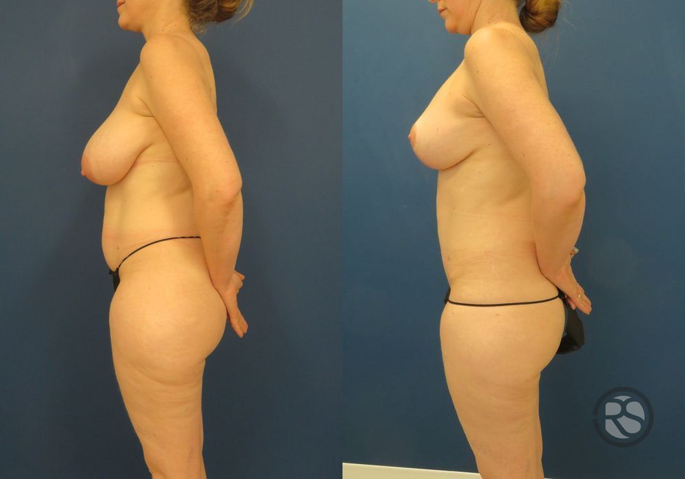 Before photo - Angle 5