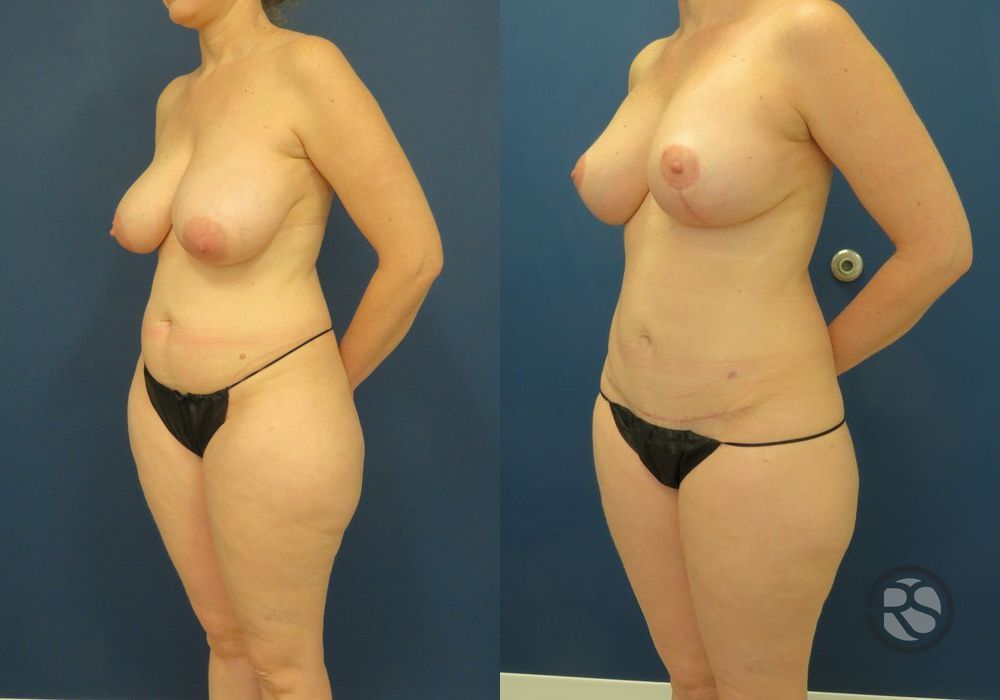 Before photo - Angle 4