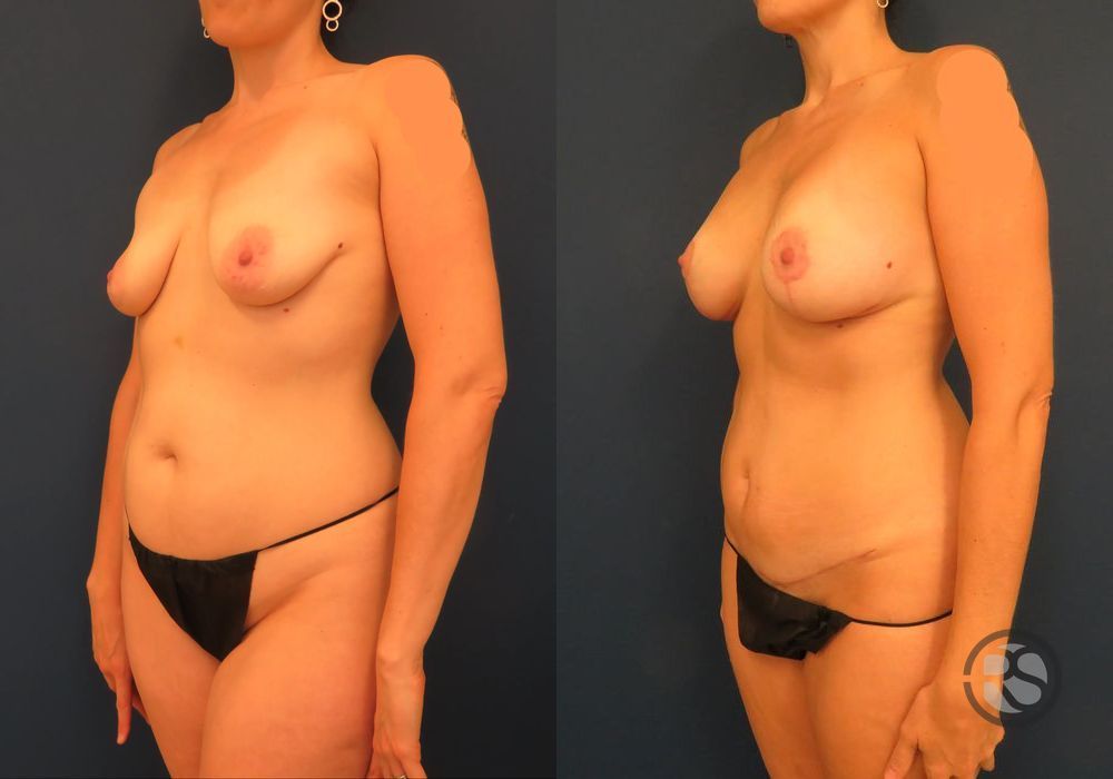 Before photo - Angle 4