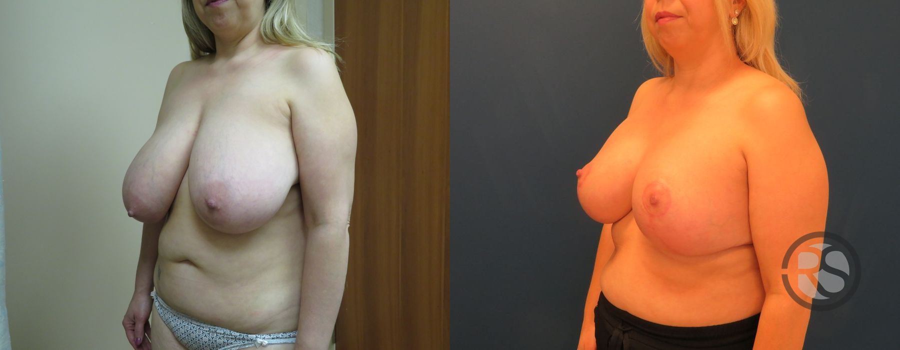 Before photo - Angle 4