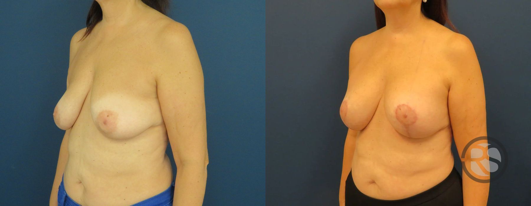 Before photo - Angle 4