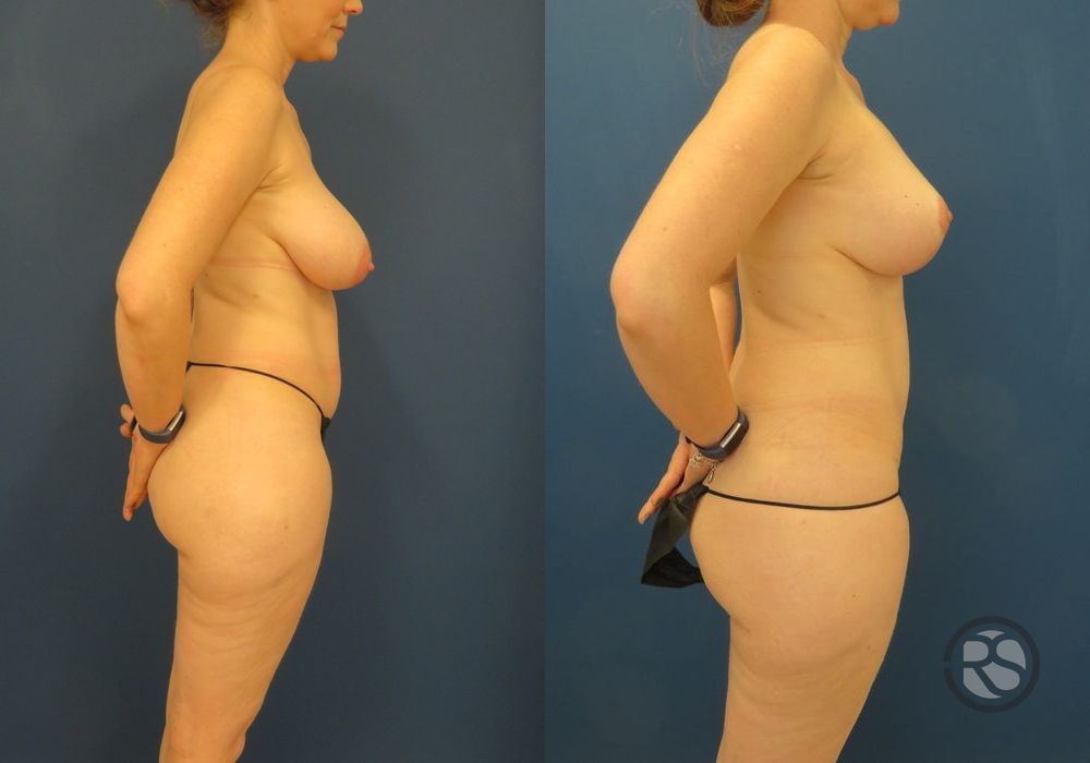 Before photo - Angle 3