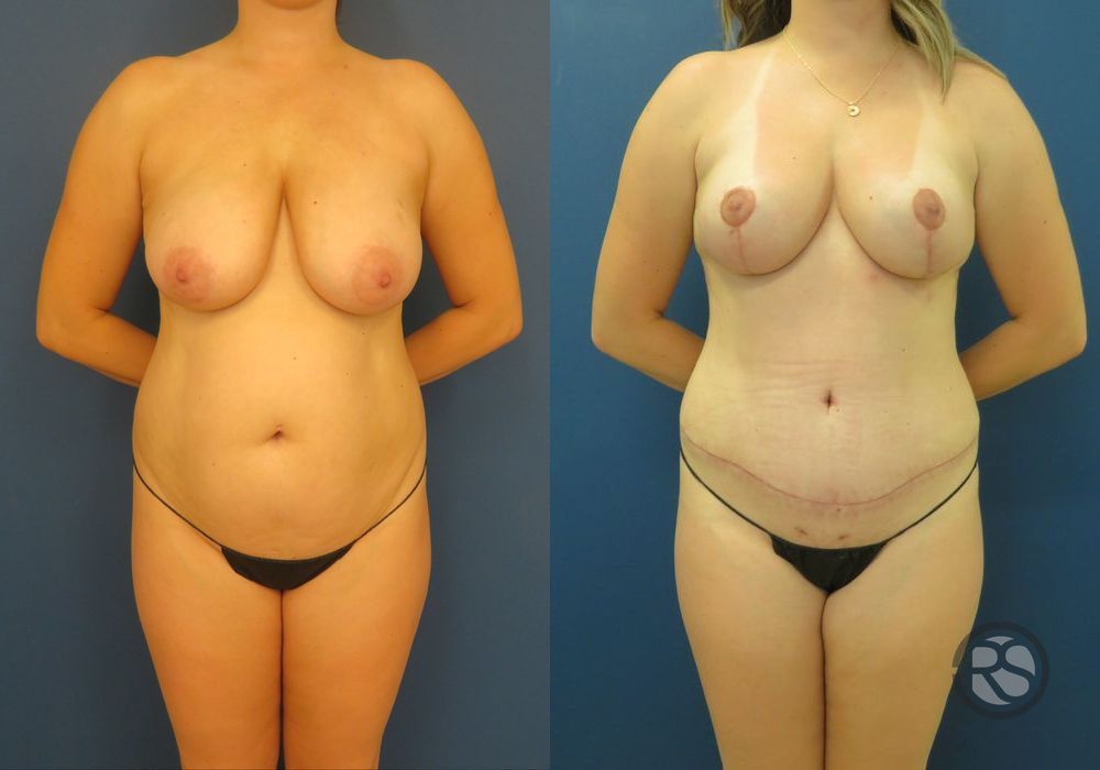 Before photo - Angle 2