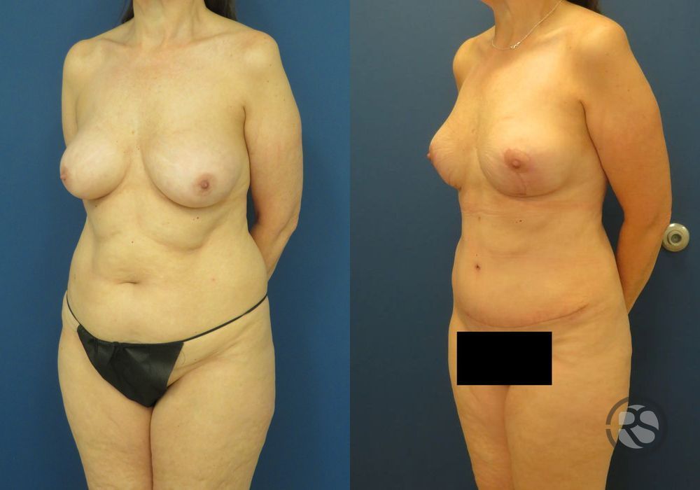 Before photo - Angle 4