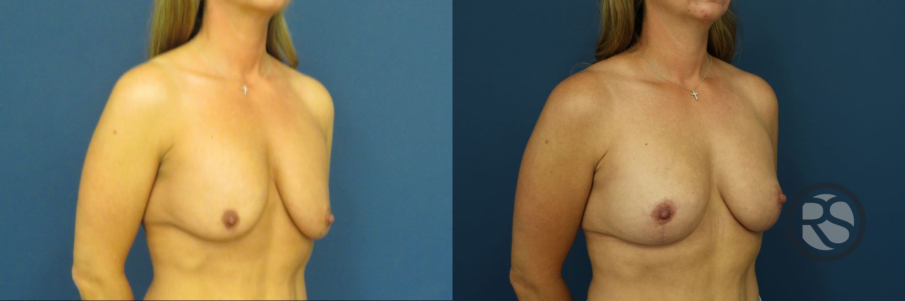 Before and after Breast Lift (Mastopexy) case 46279 - Angle 3
