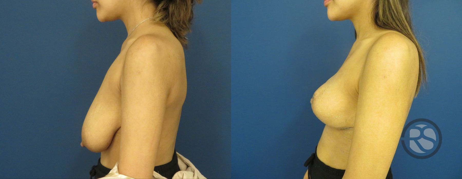 Before photo - Angle 5