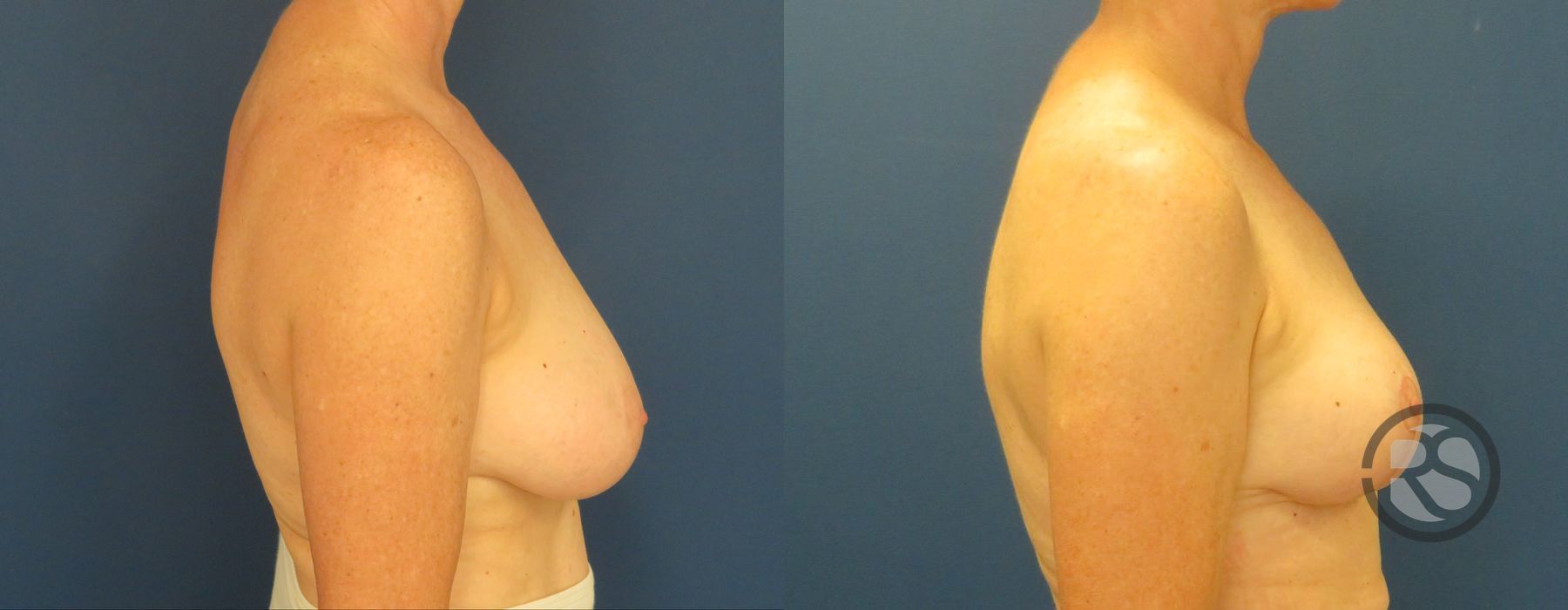 Before photo - Angle 3