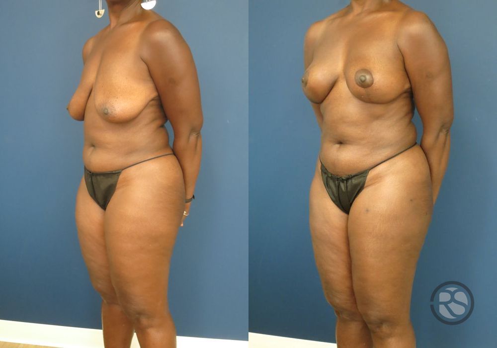 Before photo - Angle 4