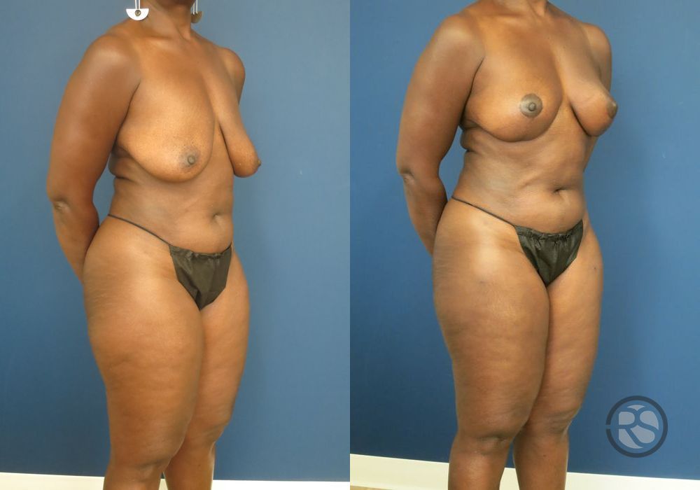 Before photo - Angle 2