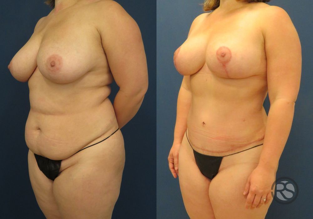 Before photo - Angle 4