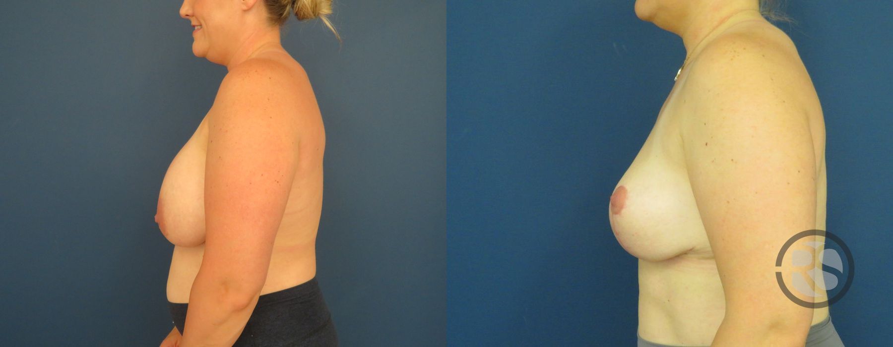 Before photo - Angle 5