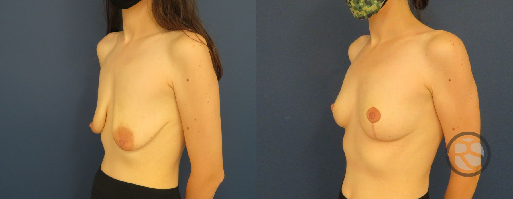 Before photo - Angle 4