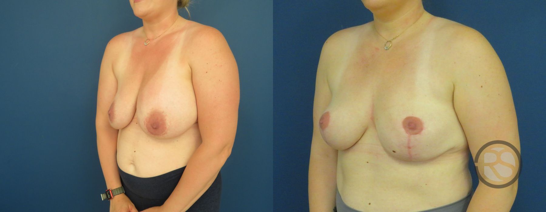 Before photo - Angle 4