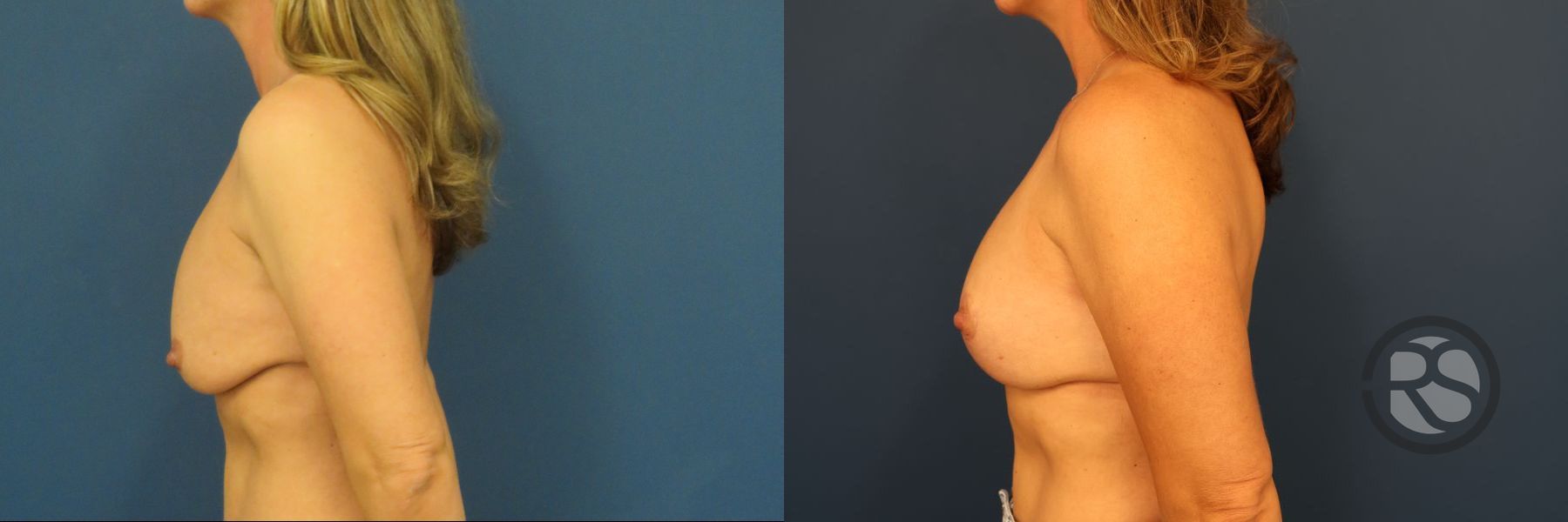Before and after Breast Lift (Mastopexy) case 46279 - Angle 5