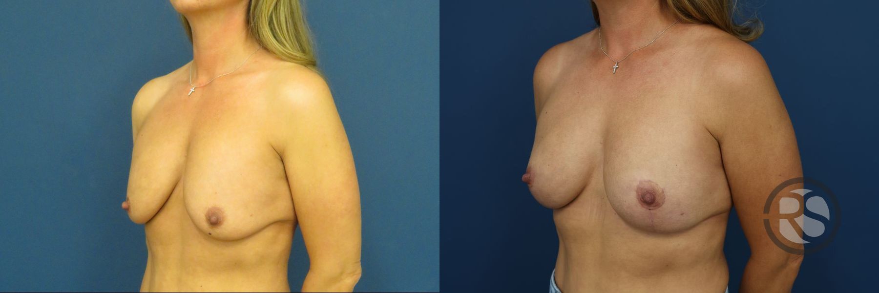 Before and after Breast Lift (Mastopexy) case 46279 - Angle 4