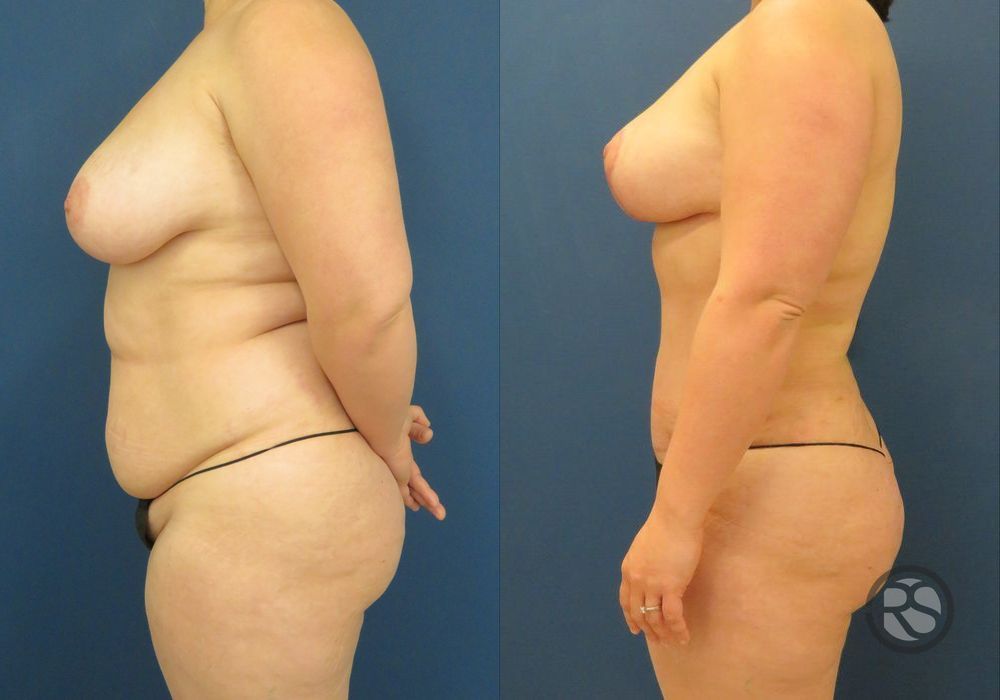 Before photo - Angle 5