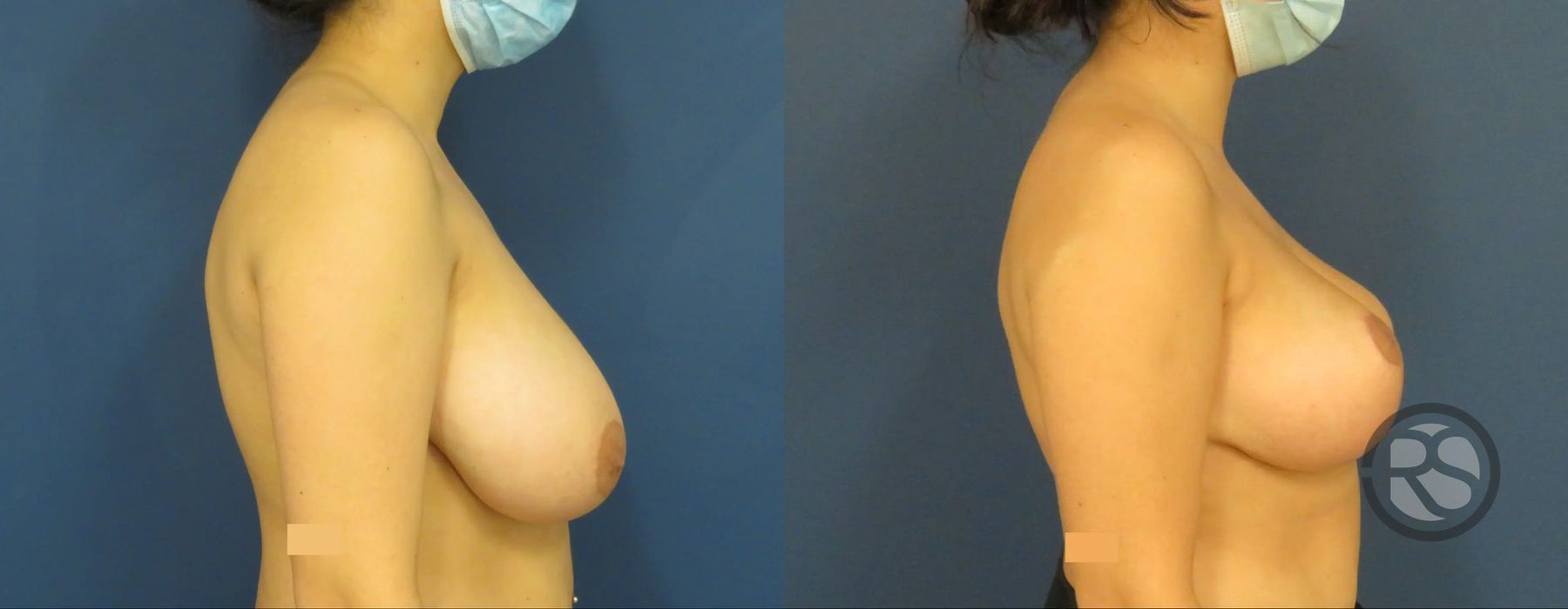 Before photo - Angle 3