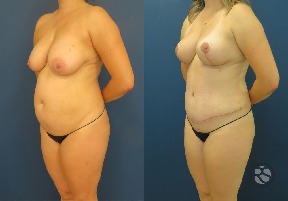 Before photo - Angle 4