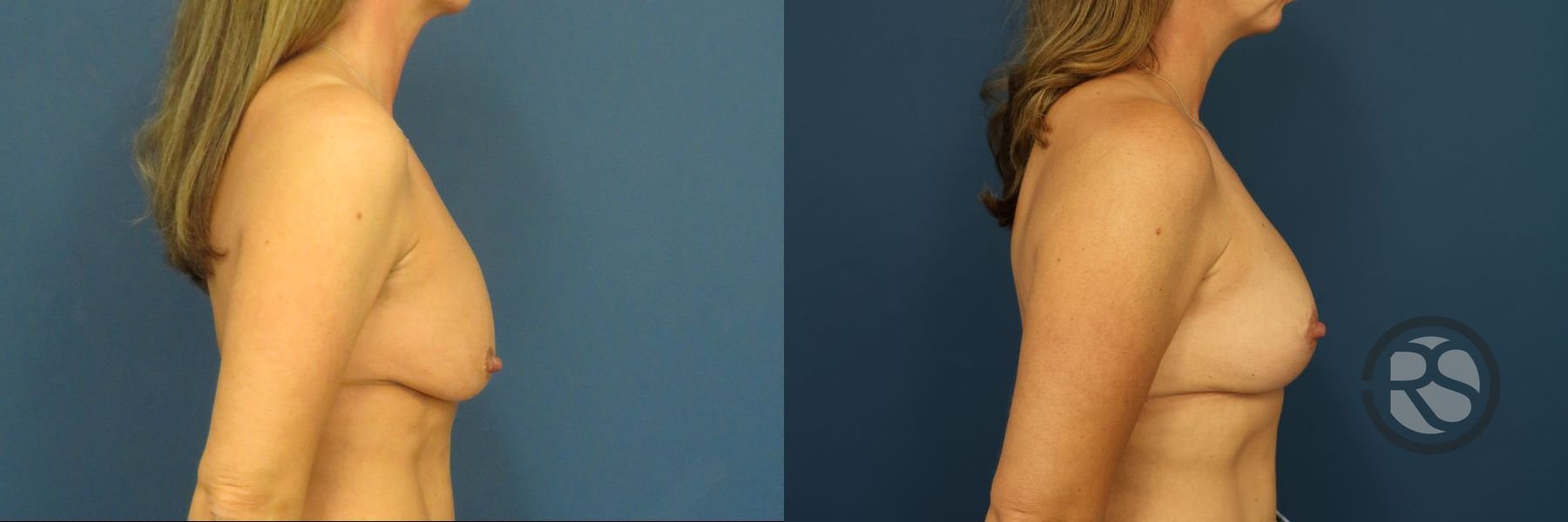 Before and after Breast Lift (Mastopexy) case 46279 - Angle 2