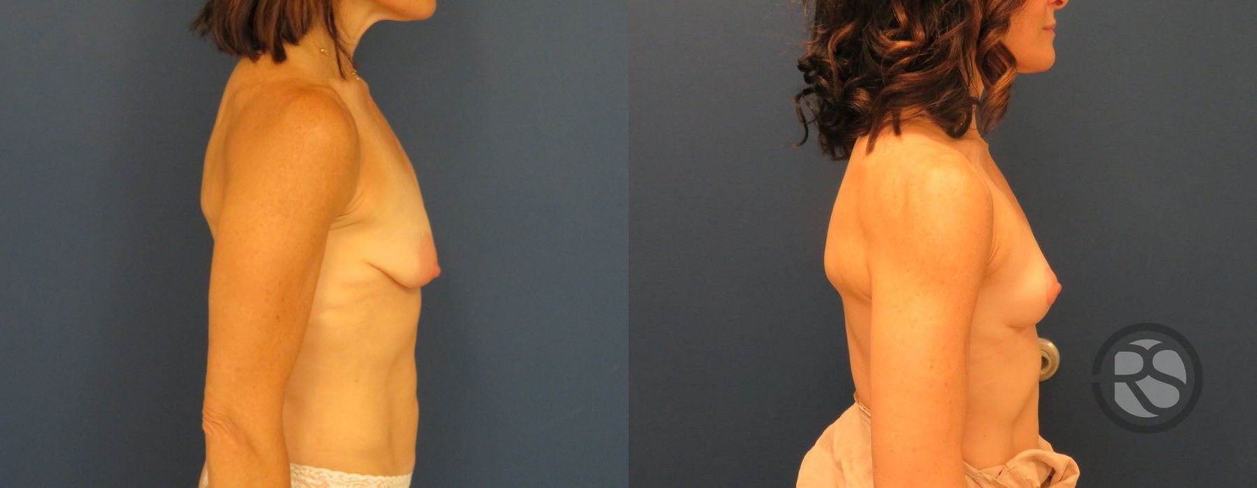 Before photo - Angle 3