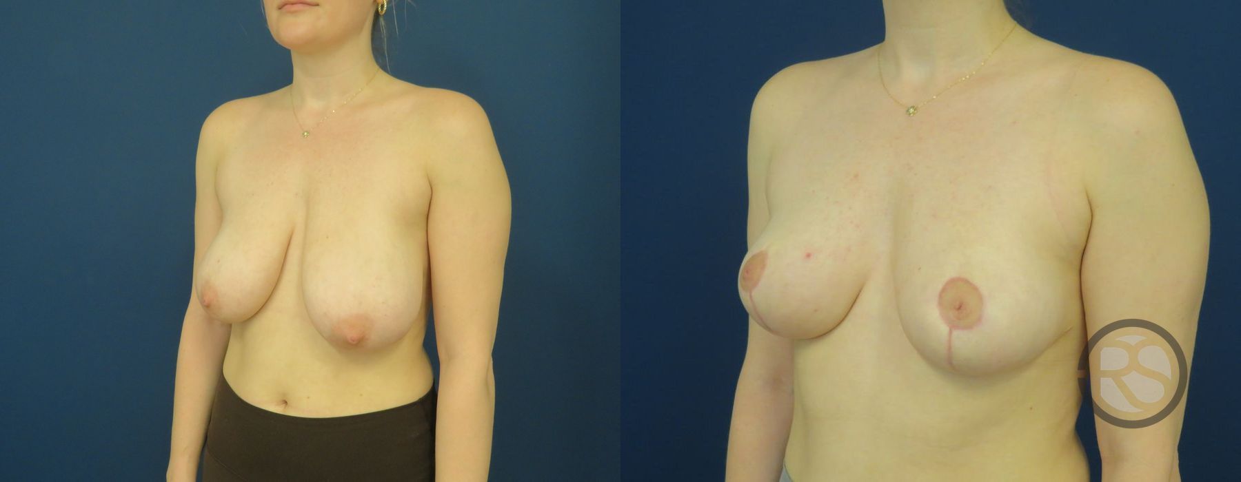 Before photo - Angle 4