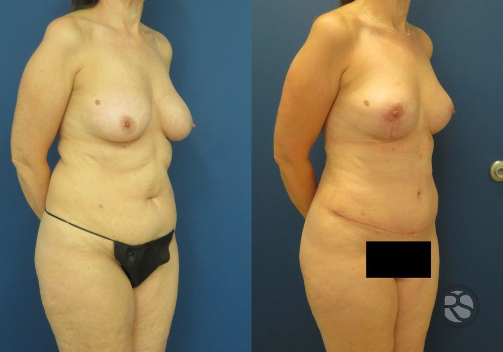 Before photo - Angle 2