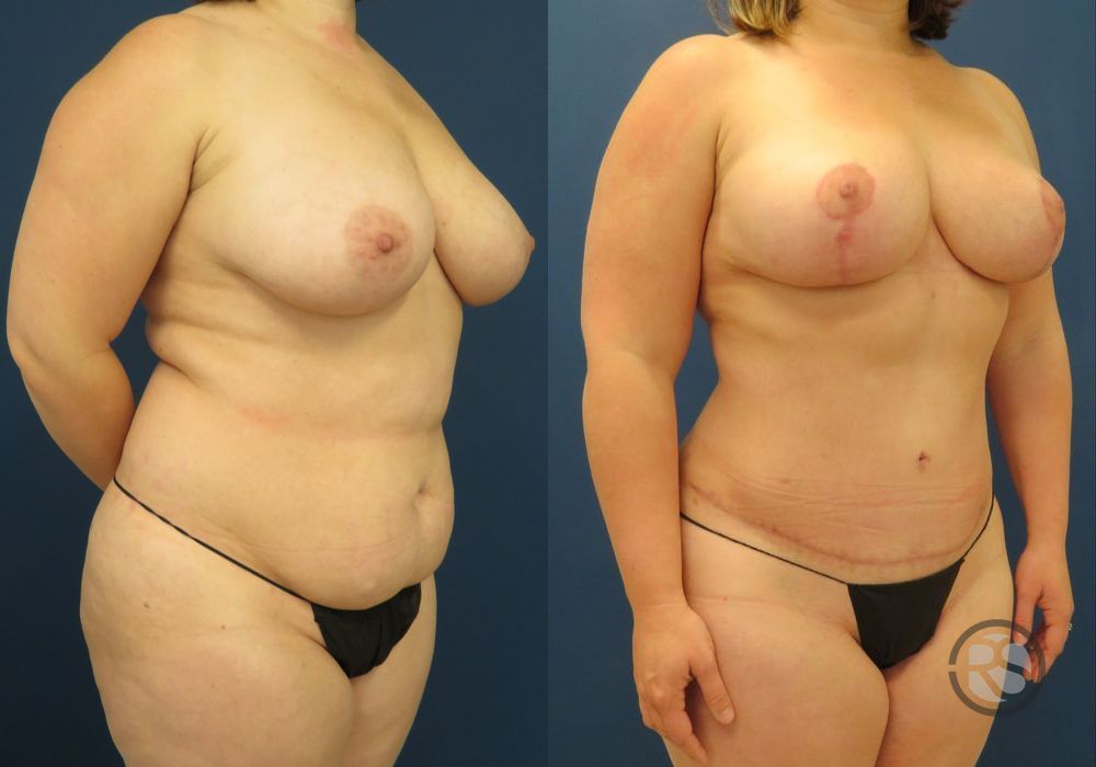 Before photo - Angle 2