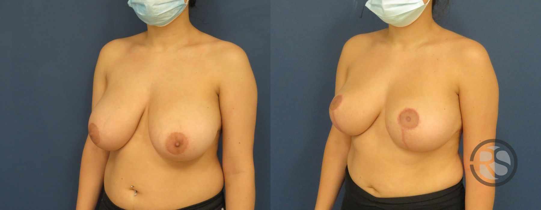 Before photo - Angle 4