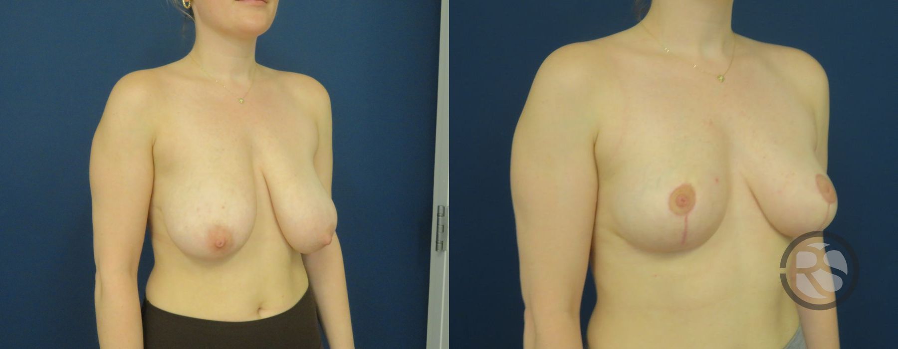 Before photo - Angle 2