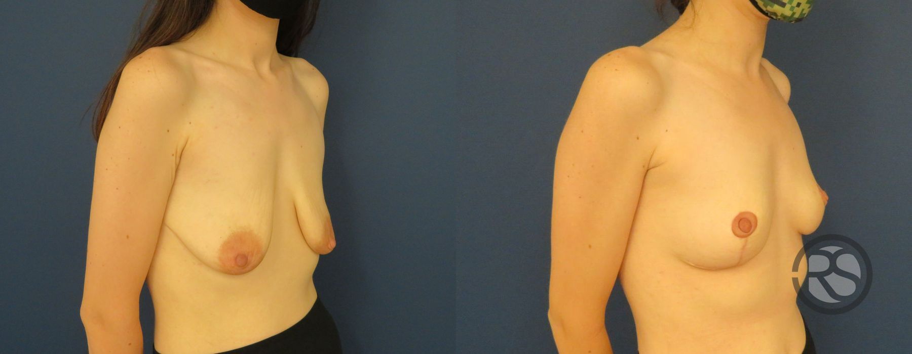 Before photo - Angle 2