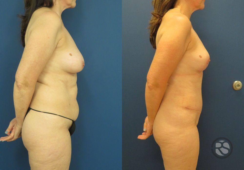 Before photo - Angle 3