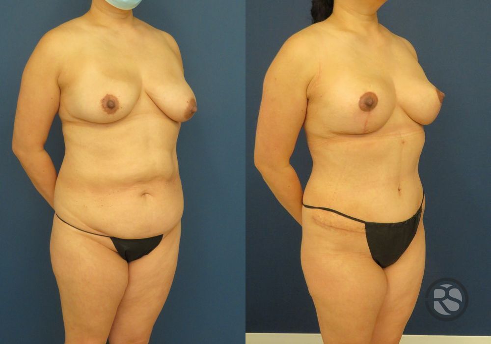 Before photo - Angle 2