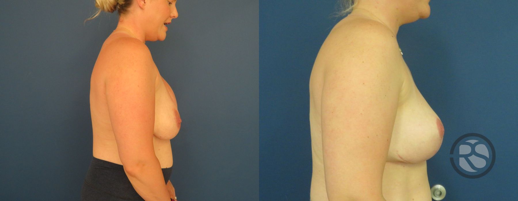 Before photo - Angle 3