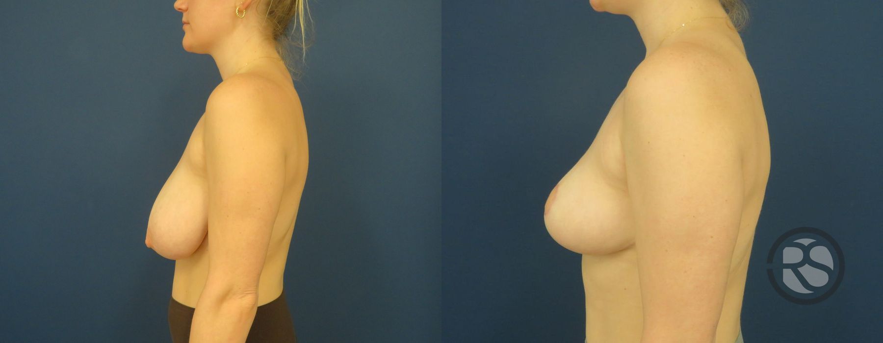 Before photo - Angle 5