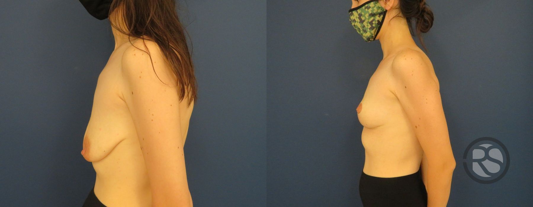 Before photo - Angle 5