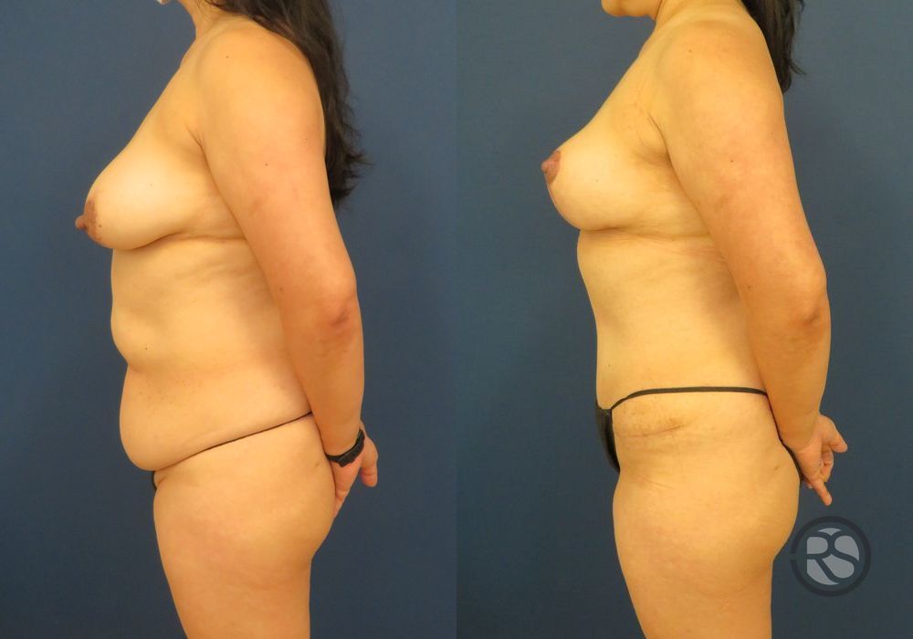 Before photo - Angle 5