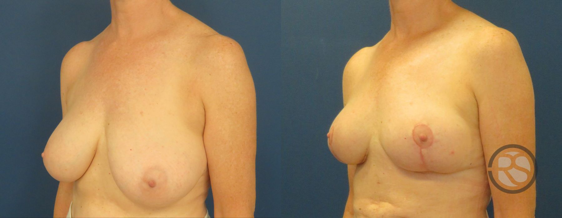 Before photo - Angle 4