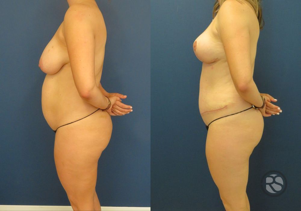 Before photo - Angle 5