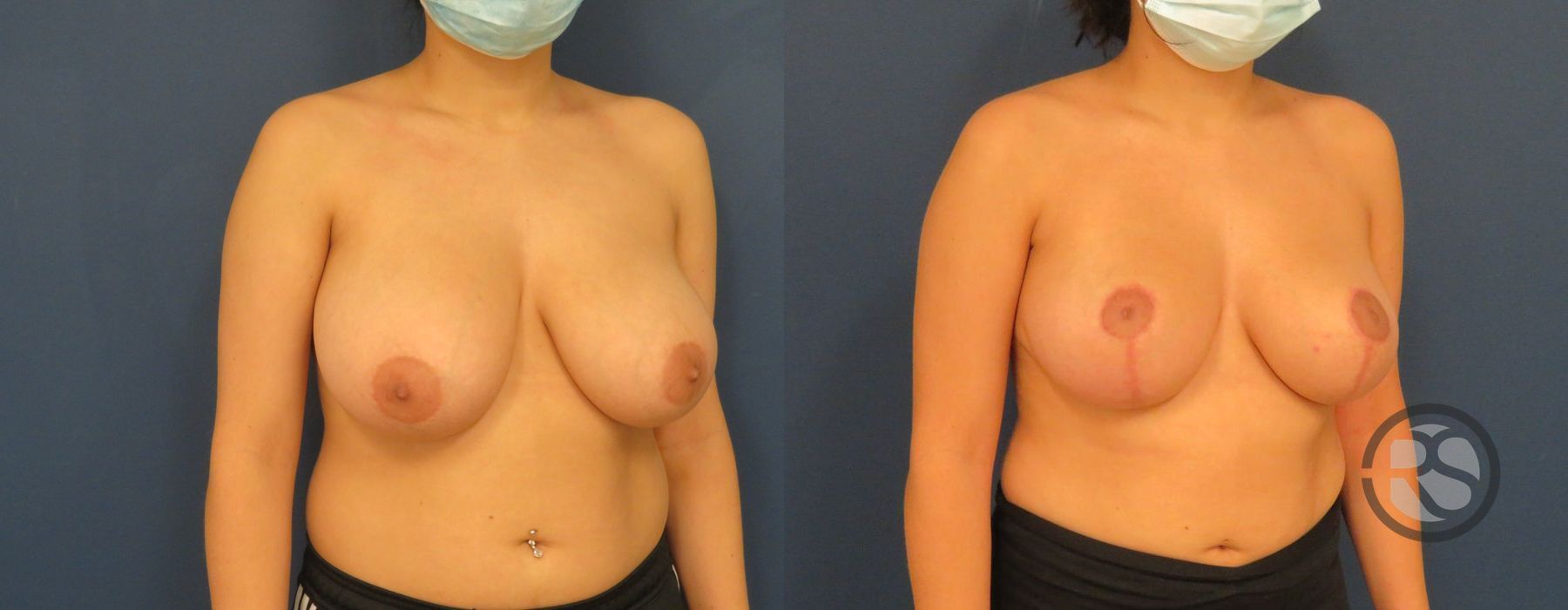 Before photo - Angle 2